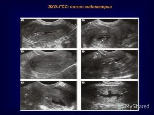 Узи после удаления полипа эндометрия как часто делать
