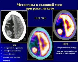 Метастазы в головном мозге при раке молочной железы прогноз