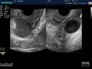 На узи объемное образование правого яичника