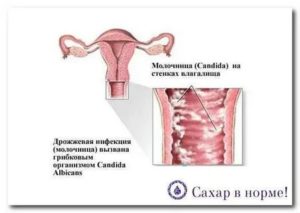Молочница при сахарном диабете у женщин симптомы лечение
