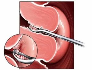 Сколько идут выделения после выскабливания при эндометриозе