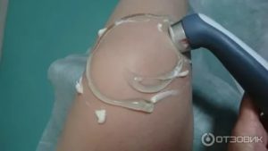 Ультразвук с гидрокортизоном при эндометриозе можно или нет