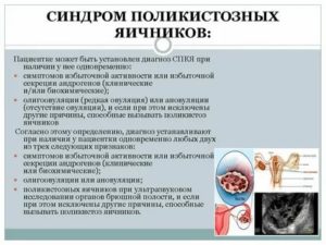 Как связаны щитовидная железа и поликистоз яичников