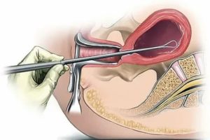 Что такое гистероскопия раздельное диагностическое выскабливание полости матки и цервикального канала