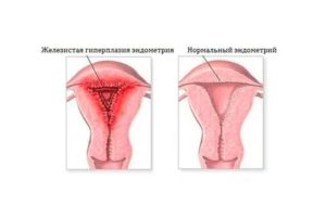 Как при гиперплазии проходит менструация