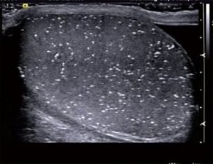 Микролитиаз яичек на узи
