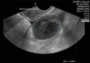 Что такое эхографические признаки кисты желтого тела