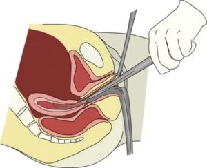 Что такое диагностика выскабливание полости матки