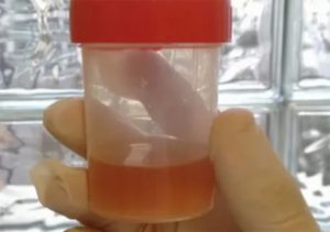 Что если при месячных моча коричневая