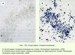 Препараты для лечения агглютинации сперматозоидов