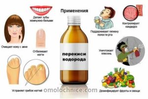 Лечение молочницы у девочек народные средства лечения