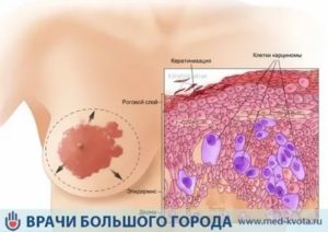 Рак педжета молочной железы симптомы и признаки