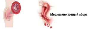 Прерывание беременности при молочнице