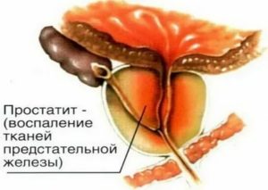 Что такое участки склероза предстательной железы