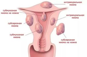 Можно ли загорать при миоме матки и кисте
