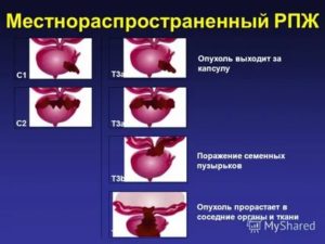 Что такое местнораспространенный рак предстательной железы