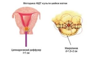 Рак культи шейки матки симптомы и