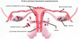 Как остановить кровотечение при эндометриозе народными средствами