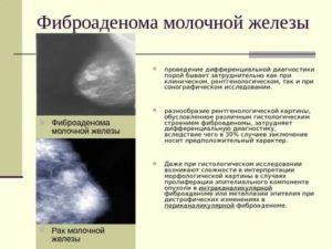 Может ли киста молочной железы перерасти в фиброаденому молочной железы