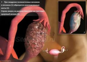Когда нужно делать операцию если есть поликистоз яичников