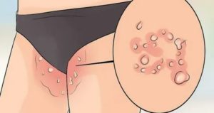 Мазь если чешется лобок