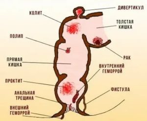 Если при простатите идет кровь из заднего прохода