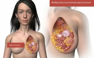 Могут ли быть уплотнения в молочной железе при климаксе