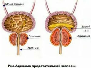 Ходьба при аденоме предстательной железы