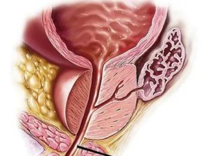 Что такое малигнизация предстательной железы