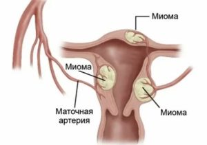 Цимицифуга при миоме и эндометриозе