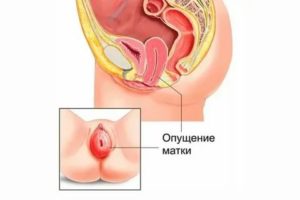 При беременности опухоль влагалища