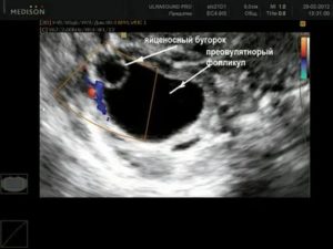 Узи после овуляции видно ли что она была