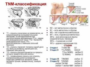 Что означает зно предстательной железы