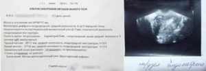 Может гинеколог определить без узи миомы матки