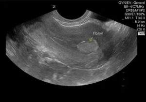 Фиброзные полипы в матке на узи