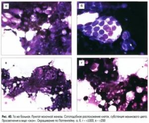 Что показывает цитология кисты молочной железы