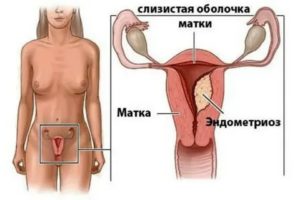 Можно ли находиться на солнце при эндометриозе