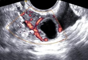Яичниковая внематочная беременность на узи