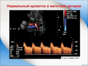 Маточно плацентарный кровоток при узи