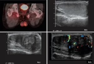 Узи органов мошонки или узи органов мошонки с допплерографией сосудов
