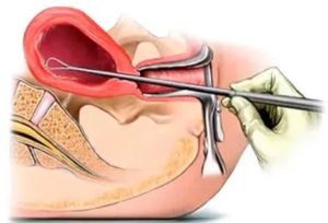Гистероскопия матки при замершей беременности