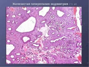 Эндометриоз железистая гиперплазия эндометрия фиброзная