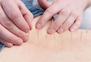 Можно ли делать иглоукалывание при эндометриозе