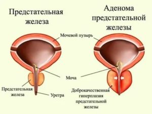 Аденома предстательной железы симптомы и лечение прополисом