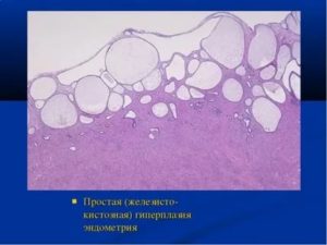 Что это такое железисто-кистозная гиперплазия эндометрия и как лечить