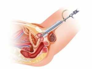 Бужирование предстательной железы у мужчин