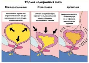 Может ли при месячных недержание мочи