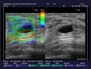 Узи молочных желез с эластографией что показывает