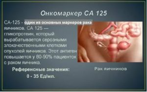 Какой показатель са 125 может быть при эндометриозе