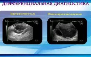 Что такое киста правого яичника папиллярная цистаденома